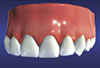 Dental Implant restored